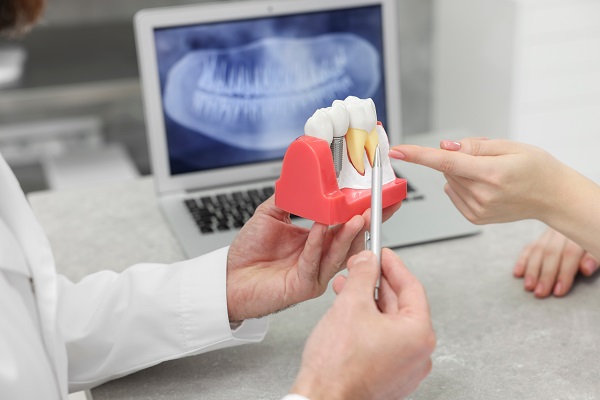 What Are Full Mouth Dental Implants?