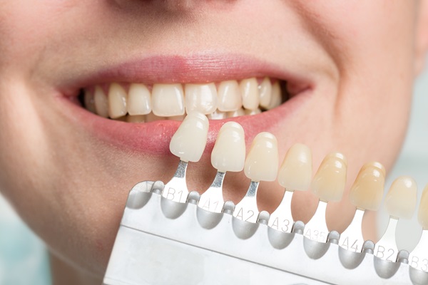 Understanding Composite Versus Porcelain Veneers